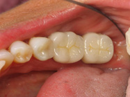 Porcelain Crowns for Teeth